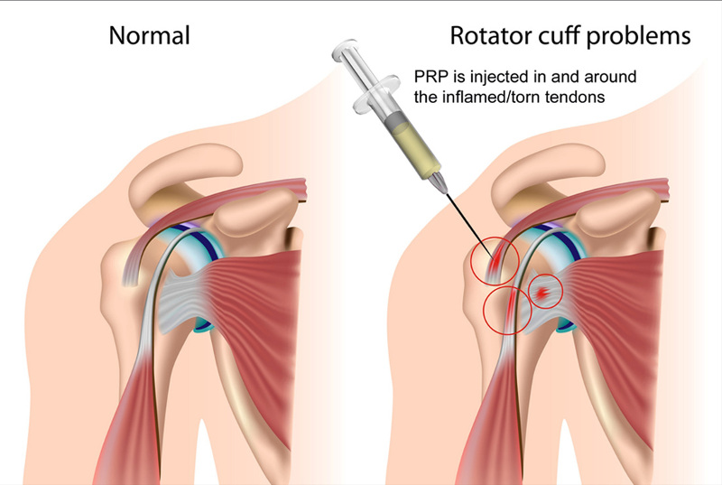 Injection PRP