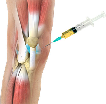 injection PRP arthrose