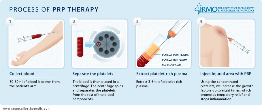 injections-de-prp-cannes-dr-gaillaud